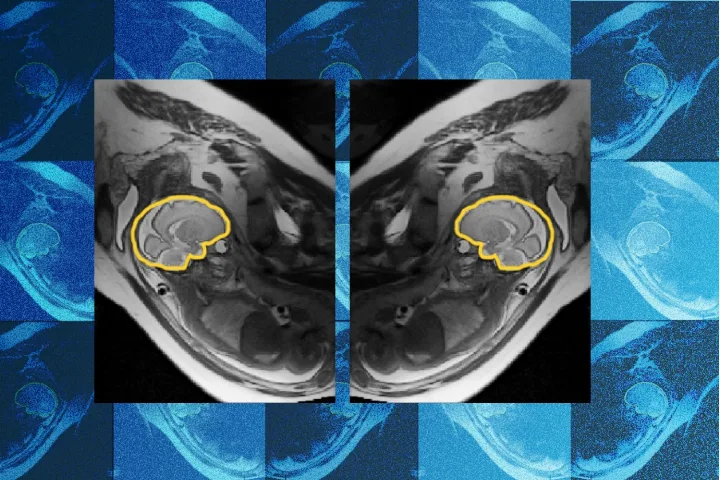 Image for: Why teaching AI about symmetry could make prenatal diagnosis more reliable